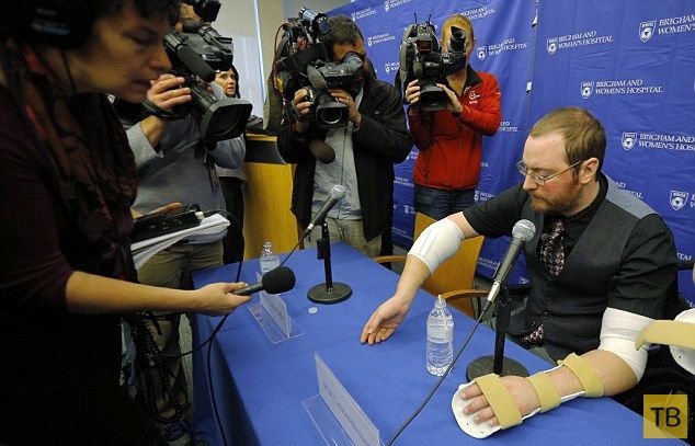 Профессору с ампутированными конечностями трансплантировали обе руки (8 фото)