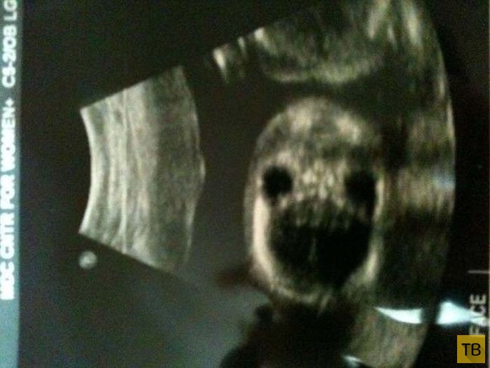 Дети в утробе матери на экранах аппаратов УЗИ (13 фото)