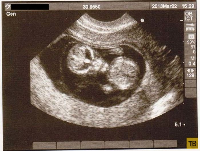 Дети в утробе матери на экранах аппаратов УЗИ (13 фото)