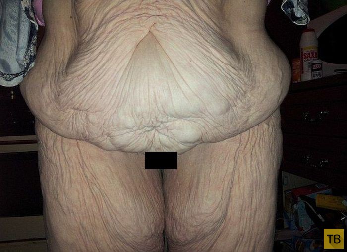 Лишняя кожа после похудения (4 фото)