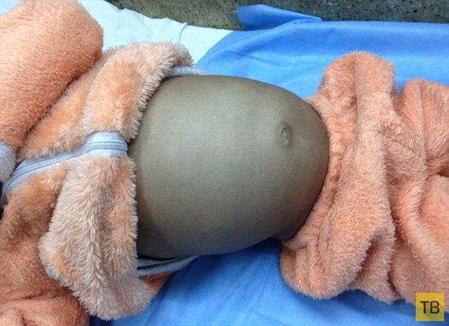 Из живота индийского мальчика хирурги вытащили метровую шевелюру (8 фото)