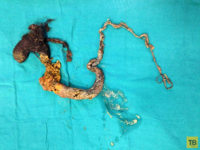 Из живота индийского мальчика хирурги вытащили метровую шевелюру (8 фото)
