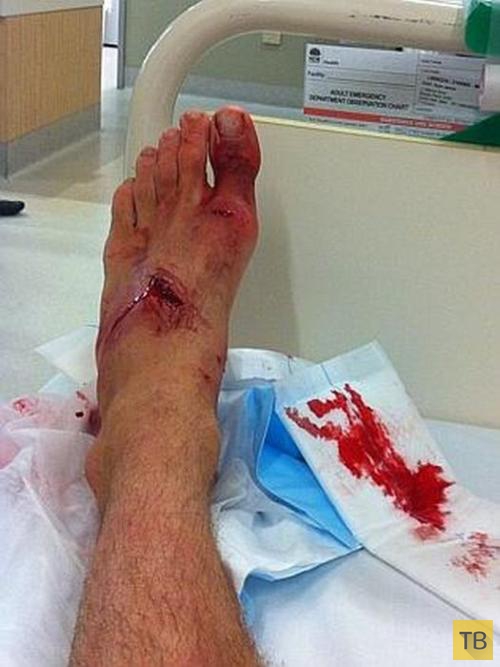 47-летний австралийский серфер отбился  от акулы голыми руками (5 фото)