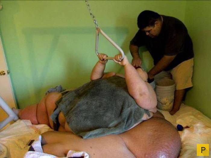 Хирурги избавили женщину от лишних 300 кг (7 фото)