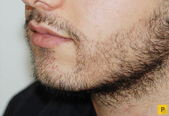 Как разбудить волосяные луковицы на лице для роста бороды