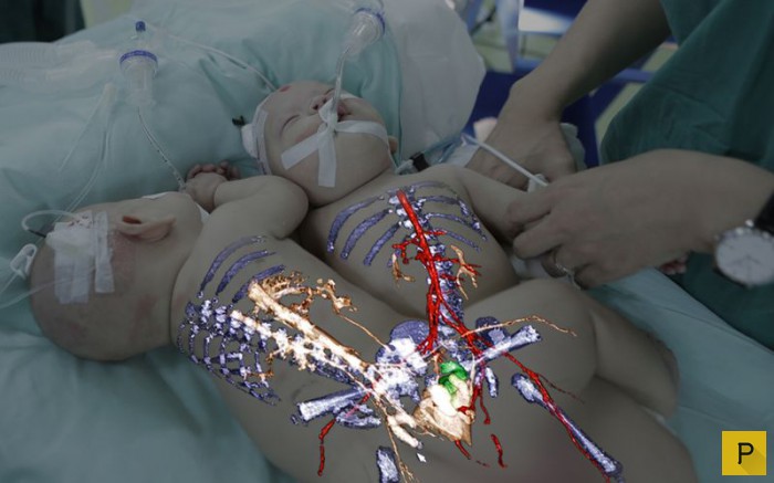 Китайские врачи провели успешную операцию по разделению сиамских близнецов с применением новых технологий (13 фото)