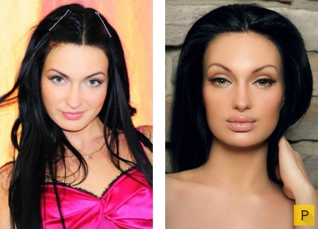 Самые похожие российские звезды: фото до и после пластики