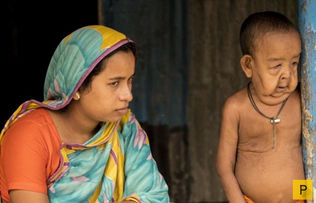 В Бангладеш родился мальчик, который выглядит как 80-летний старик