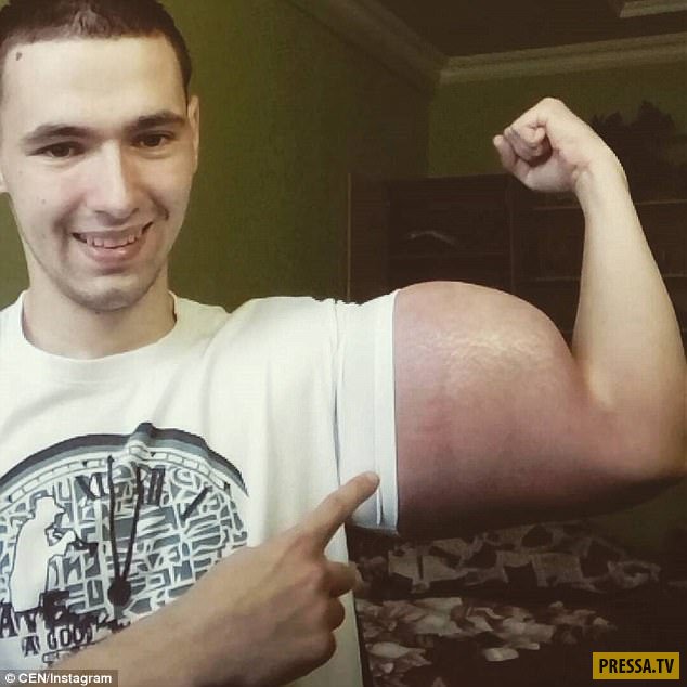 Опасно для жизни: россиянин накачал мышцы синтолом и стал фриком (10 фото)