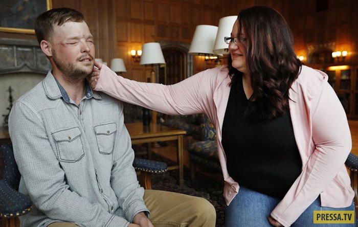 Лили Росс встретила мужчину, которому пересадили лицо ее мужа (5 фото + видео)