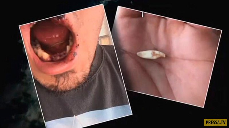 Гаваец потерял зубы и получил множественные ожоги после взрыва электронной сигареты (3 фото)