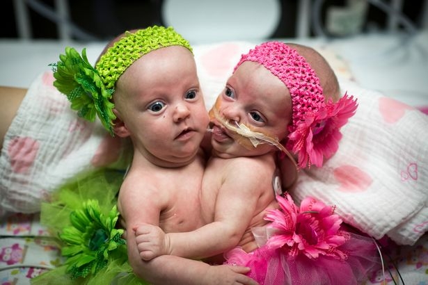 Годовалые сиамские близнецы-девочки удачно разделены в ходе 7-часовой операции