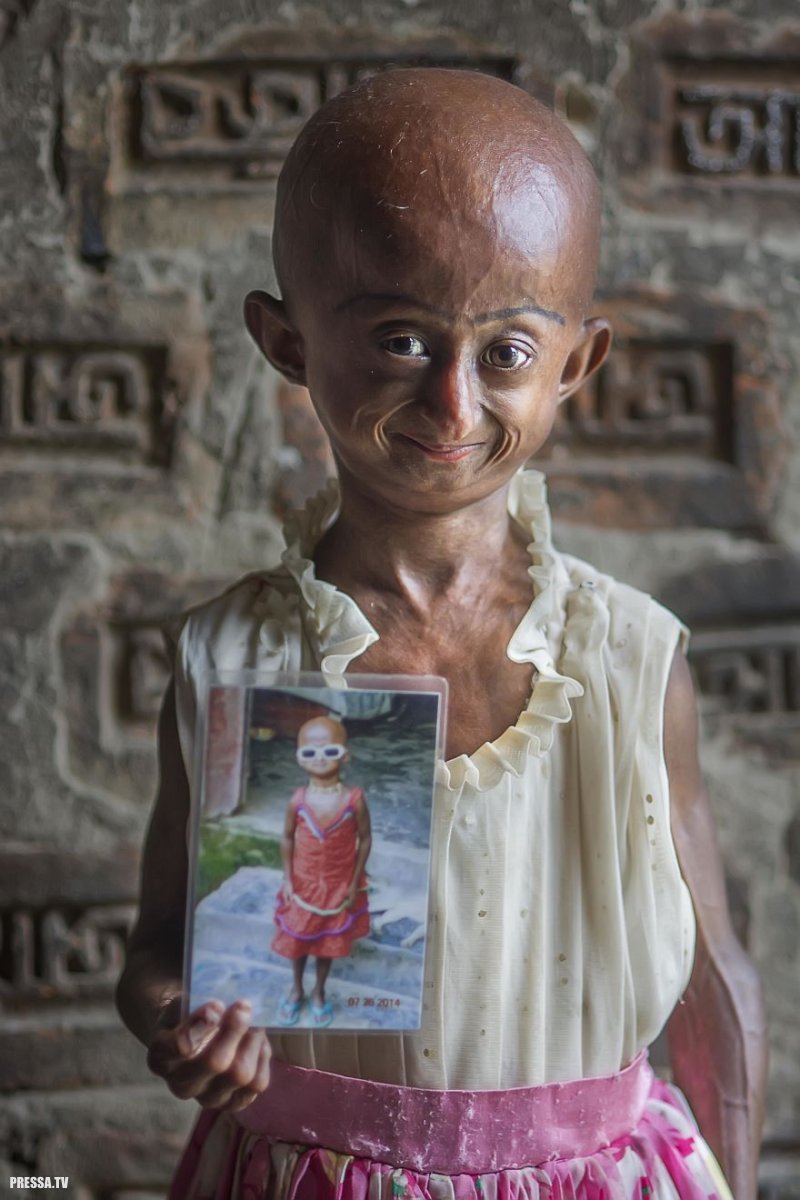 Девочке, страдающей прогерией, осталось жить не более трех лет