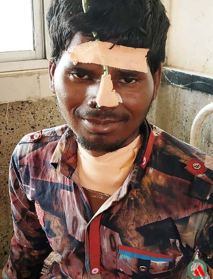 Индийские врачи спасли психически нездорового мужчину, проглотившего замок