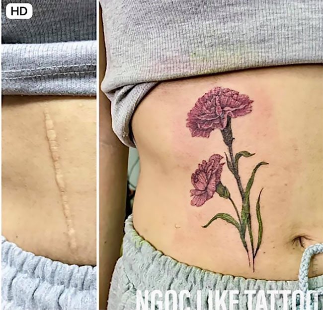 Вьетнамская татуировщица умело маскирует шрамы