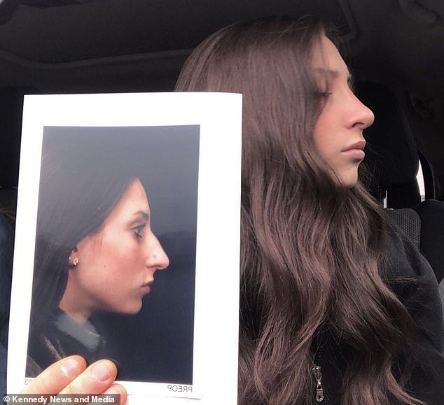 Молодая визажистка потратила 10 000 долларов на пластику носа